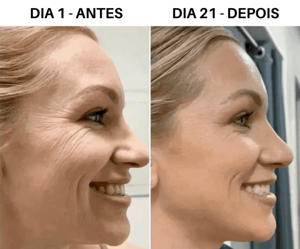 Antes e depois do uso do Massageador Facial LED CICLO